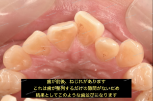 部分矯正による歯のガタガタ（叢生）治療です。隙間がない状態です。